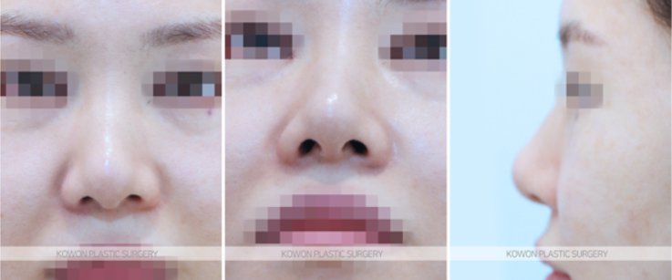 Q. 용코수술 고민, 콧구멍 모양 교정 필요할까? 사진 4
