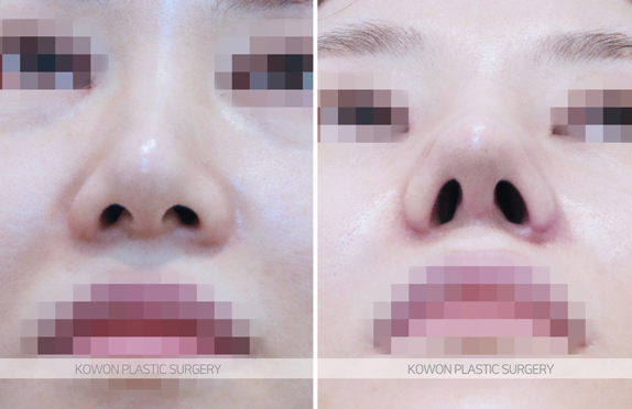 복코수술전후 변화 과정과 코끝 구조 개선 흐름 함께 보기 사진 7