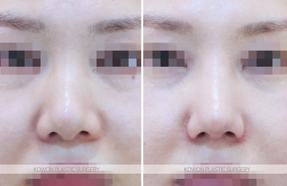 복코수술전후 변화 과정과 코끝 구조 개선 흐름 함께 보기 사진 8