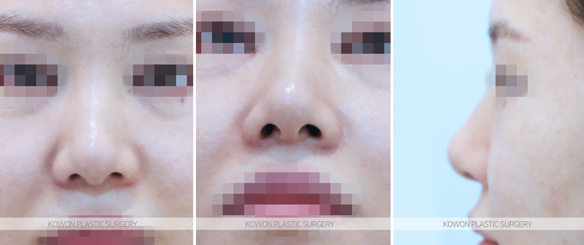 복코수술전후 변화 과정과 코끝 구조 개선 흐름 함께 보기 사진 5