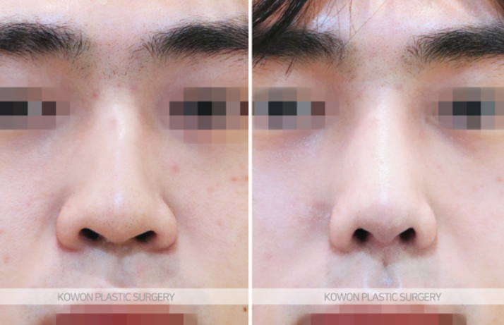 남자코성형전후 모습으로 확인하는 매부리코 교정 & 코끝 라인 긍정적 변화 사진 5