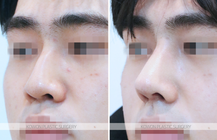 남자코성형전후 모습으로 확인하는 매부리코 교정 & 코끝 라인 긍정적 변화 사진 6