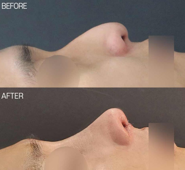 남자코성형전후 모습으로 확인하는 매부리코 교정 & 코끝 라인 긍정적 변화 사진 2
