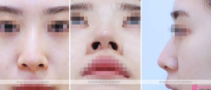 복코코끝성형 전후, 퍼진 코끝과 둔한 콧대 개선 과정 알아봐요 사진 4