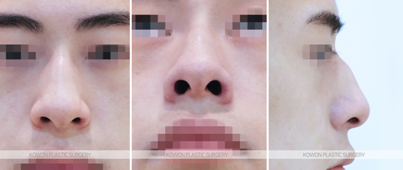 남자 매부리코 수술하면 인상 얼마나 달라지나요? 전후 변화와 회복기간 정리 사진 4