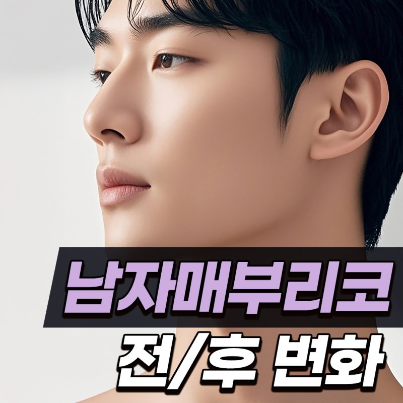 남자 매부리코 수술하면 인상 얼마나 달라지나요? 전후 변화와 회복기간 정리