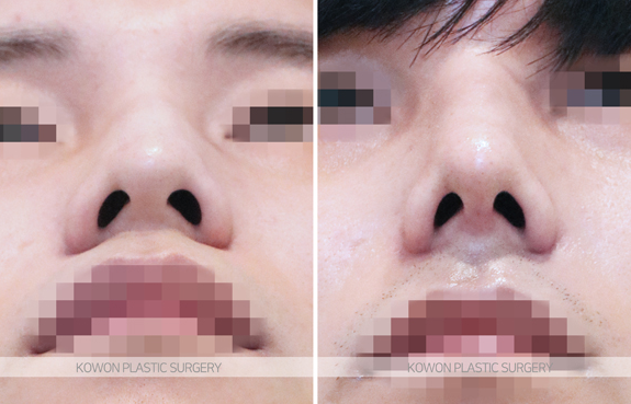 남자코성형잘하는곳 선택 기준 무엇일까요? 매부리코 전후 변화로 정리 사진 6