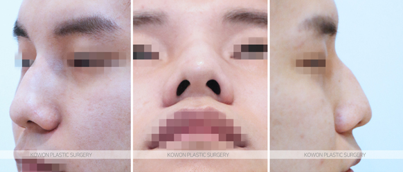 남자코성형잘하는곳 선택 기준 무엇일까요? 매부리코 전후 변화로 정리 사진 4