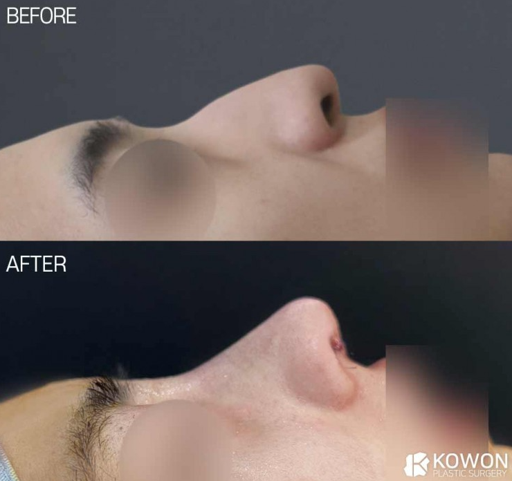 남자코성형잘하는곳 선택 기준 무엇일까요? 매부리코 전후 변화로 정리 사진 3