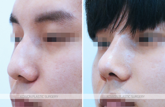 남자코성형잘하는곳 선택 기준 무엇일까요? 매부리코 전후 변화로 정리 사진 7