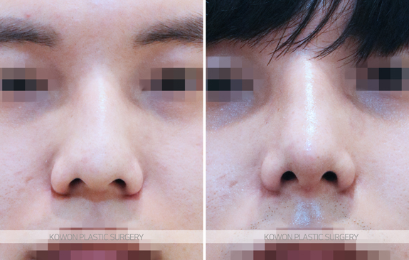 남자코성형잘하는곳 선택 기준 무엇일까요? 매부리코 전후 변화로 정리 사진 5