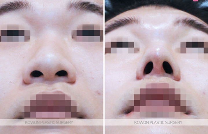 주먹코 수술 언제 자연스러워지나요? 직후 변화와 회복기간 정리 사진 5