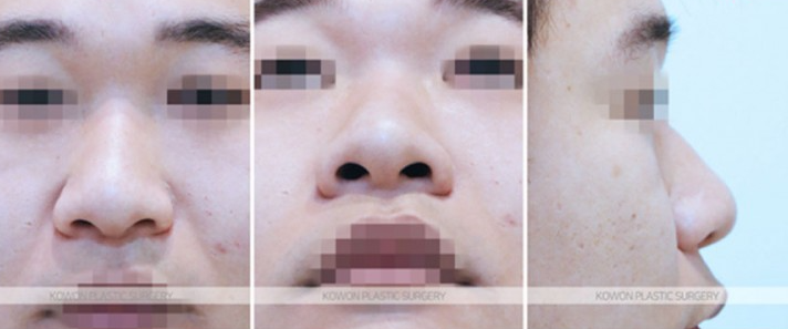 주먹코 수술 언제 자연스러워지나요? 직후 변화와 회복기간 정리 사진 4