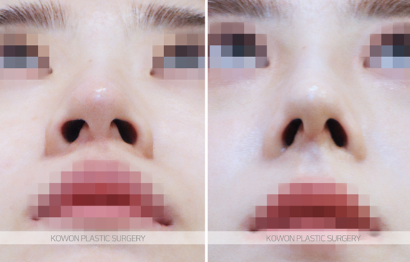 휜코성형 하면 복코도 함께 개선되나요? 비대칭 변화 과정 정리 사진 7