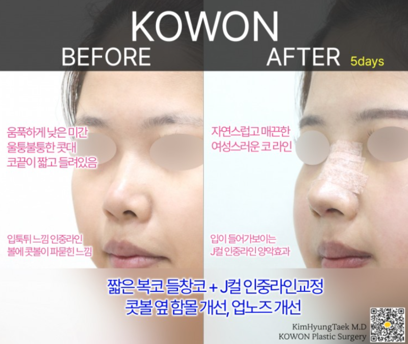 짧은코 성형 전후 얼마나 변할까? 짧은코 변화 과정과 회복까지 사진 8