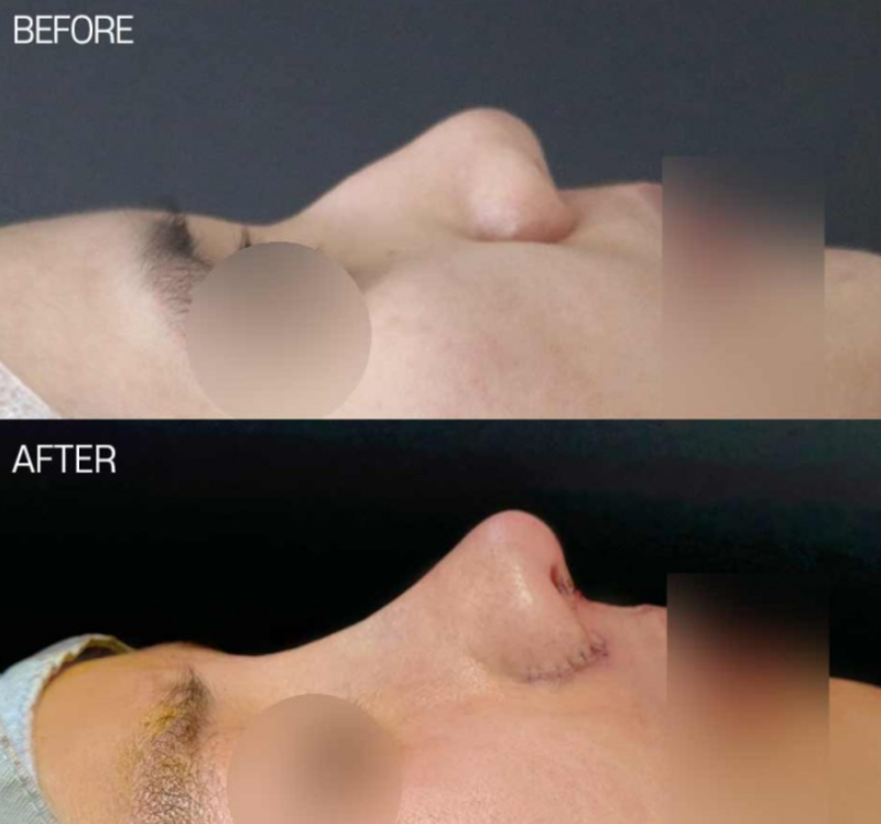매부리코성형 전후 얼마나 차이날까? 복코와 넓은 콧볼까지 함께 고려한 변화 사진 2