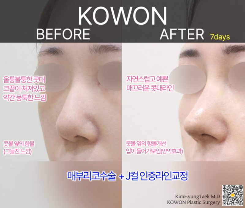 매부리코성형 전후 얼마나 차이날까? 복코와 넓은 콧볼까지 함께 고려한 변화 사진 7