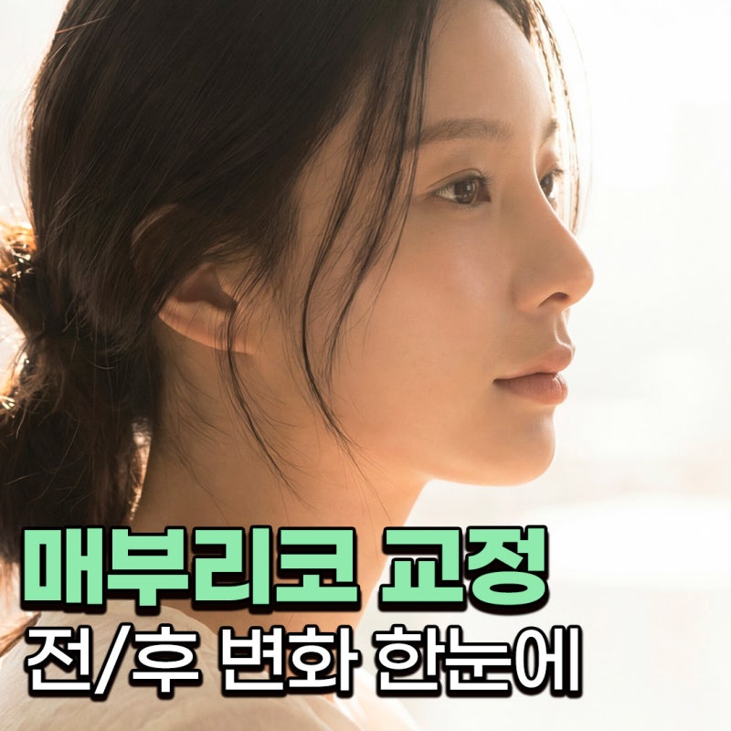 매부리코성형 전후 얼마나 차이날까? 복코와 넓은 콧볼까지 함께 고려한 변화