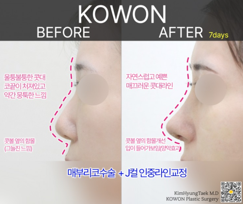 매부리코성형 전후 얼마나 차이날까? 복코와 넓은 콧볼까지 함께 고려한 변화 사진 4