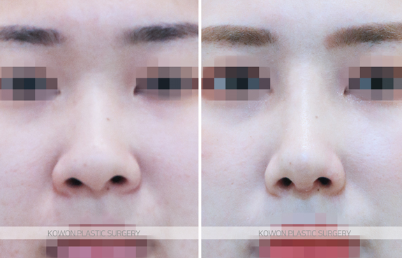 코끝연골재배치 어떤 변화가 나타날까요? 복코 라인 개선 과정 정리 사진 7