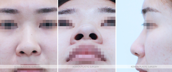 코끝연골재배치 어떤 변화가 나타날까요? 복코 라인 개선 과정 정리 사진 4