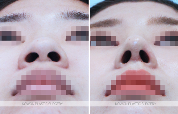 코끝연골재배치 어떤 변화가 나타날까요? 복코 라인 개선 과정 정리 사진 6