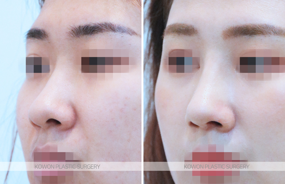 코끝연골재배치 어떤 변화가 나타날까요? 복코 라인 개선 과정 정리 사진 5
