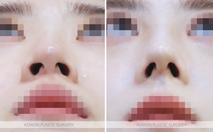 낮은코성형 입체적인 인상으로 변화, 코끝연골재배치 질문 3가지 사진 10