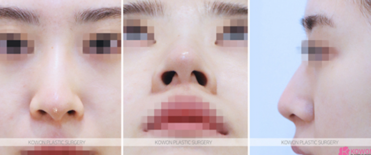 낮은코성형 입체적인 인상으로 변화, 코끝연골재배치 질문 3가지 사진 5