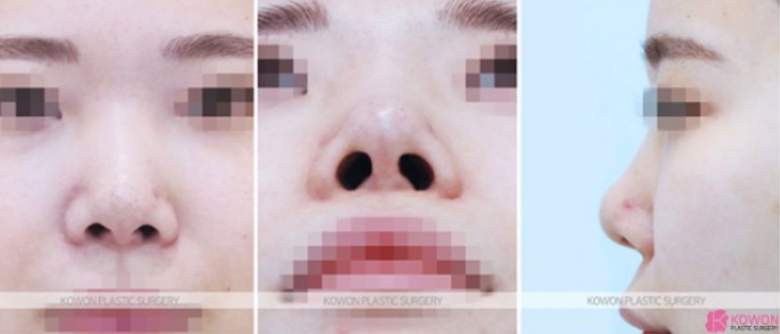 자가늑연골코수술 자연스러울까요? 처진 코끝과 미간 라인까지 정리한 과정 사진 5