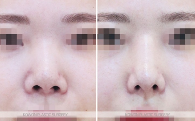 자가늑연골코수술 자연스러울까요? 처진 코끝과 미간 라인까지 정리한 과정 사진 6