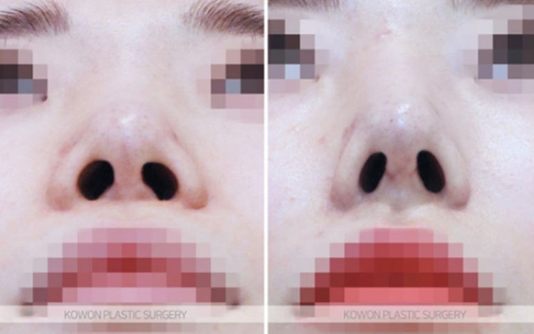자가늑연골코수술 자연스러울까요? 처진 코끝과 미간 라인까지 정리한 과정 사진 7
