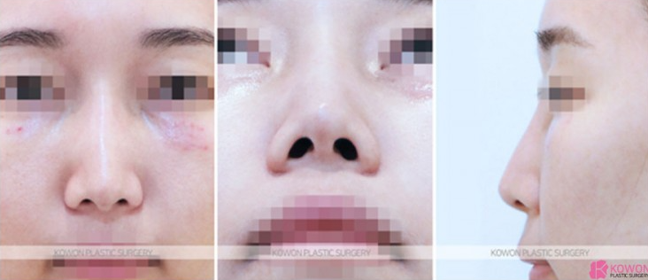 자려한코성형이란 무엇인가요? 작은코성형 고민 중이라면 확인하세요 사진 5
