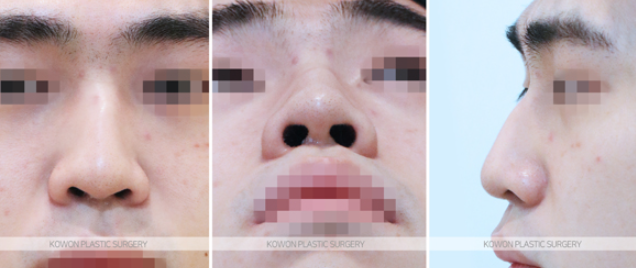 남자매부리코 교정, 비중격만곡증까지 함께 고려해야 하는 이유 사진 4