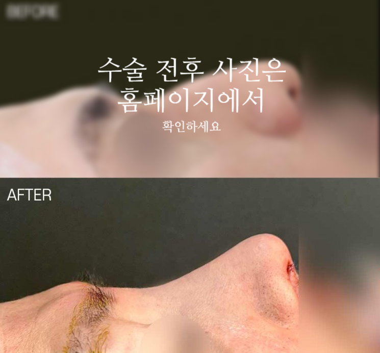 남자매부리코 교정, 비중격만곡증까지 함께 고려해야 하는 이유 사진 2