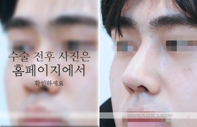 남자매부리코 교정, 비중격만곡증까지 함께 고려해야 하는 이유 사진 6