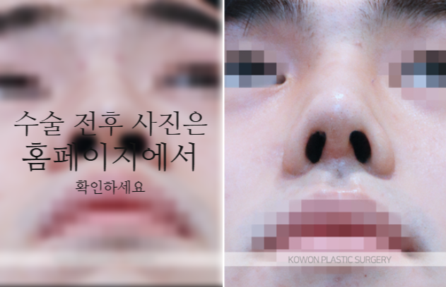 남자매부리코 교정, 비중격만곡증까지 함께 고려해야 하는 이유