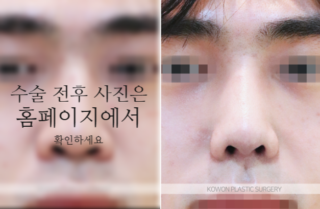 남자매부리코 교정, 비중격만곡증까지 함께 고려해야 하는 이유 사진 5