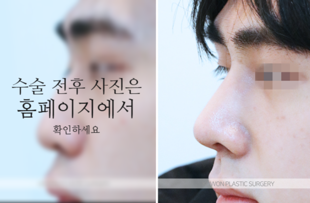 남자매부리코 교정, 비중격만곡증까지 함께 고려해야 하는 이유 사진 8
