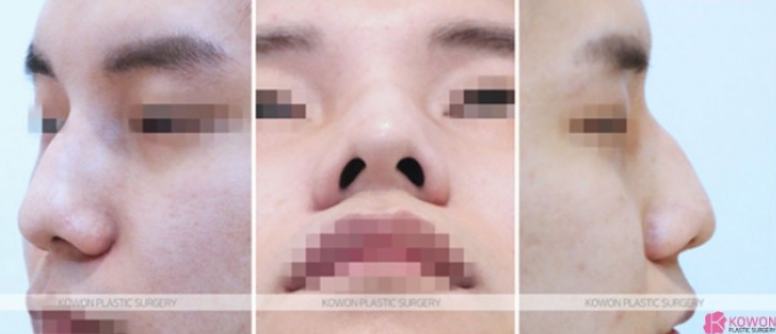 비중격만곡증 수술 회복기간과 남자코 균형을 결정하는 핵심 요소 3가지 사진 6