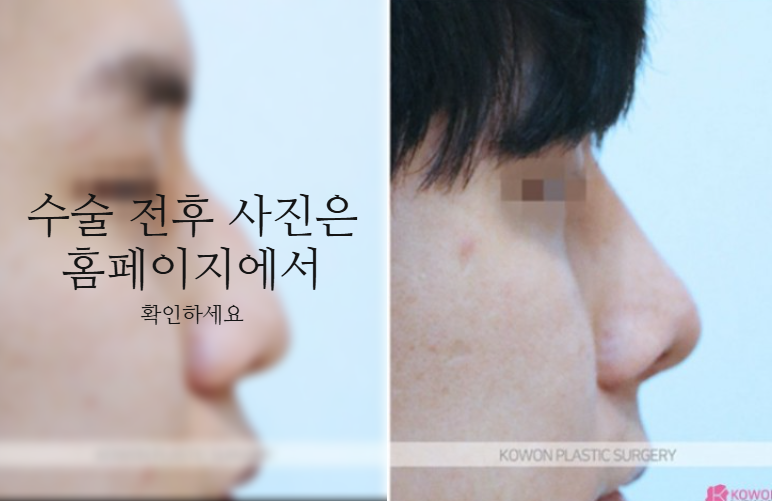 비중격만곡증 수술 회복기간과 남자코 균형을 결정하는 핵심 요소 3가지 사진 10