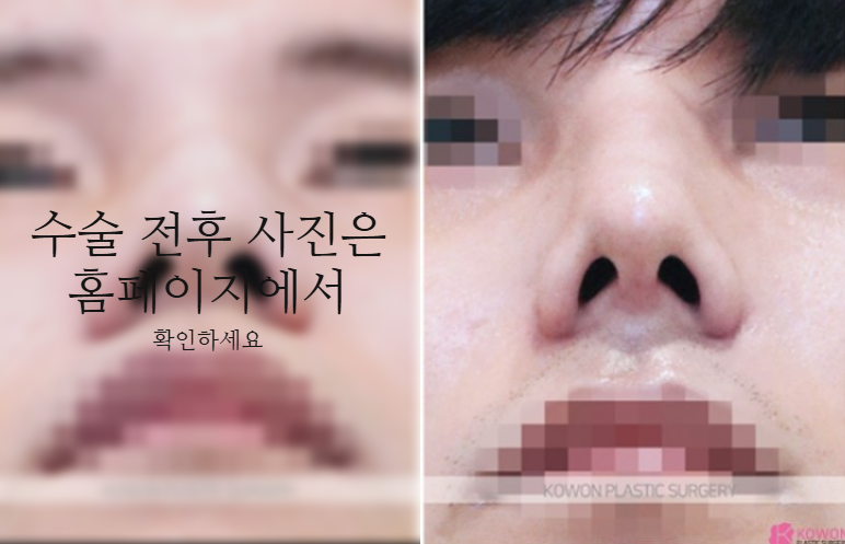 비중격만곡증 수술 회복기간과 남자코 균형을 결정하는 핵심 요소 3가지 사진 9