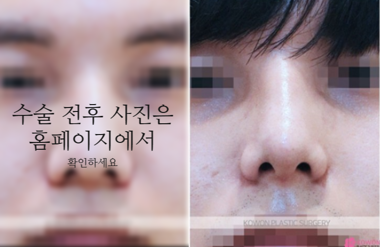 비중격만곡증 수술 회복기간과 남자코 균형을 결정하는 핵심 요소 3가지 사진 8
