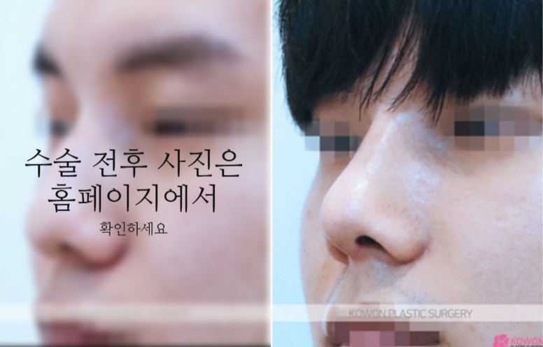 비중격만곡증 수술 회복기간과 남자코 균형을 결정하는 핵심 요소 3가지 사진 7