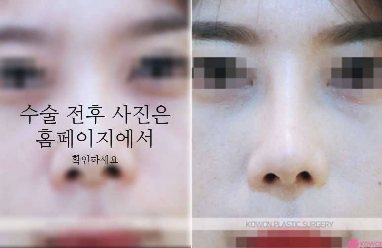 작은코성형에서 입체감 있는 코 라인을 만드는 핵심 3가지 사진 9