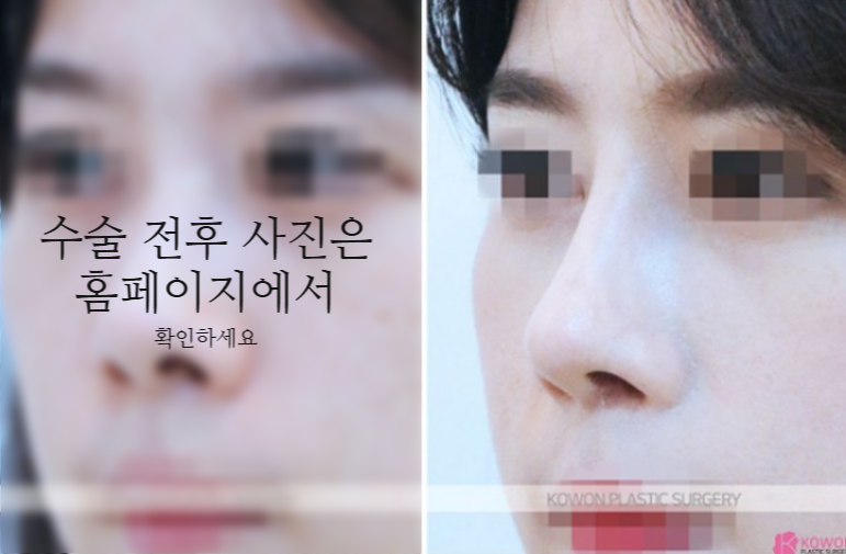 작은코성형에서 입체감 있는 코 라인을 만드는 핵심 3가지 사진 7