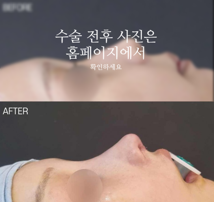 작은코성형에서 입체감 있는 코 라인을 만드는 핵심 3가지 사진 2