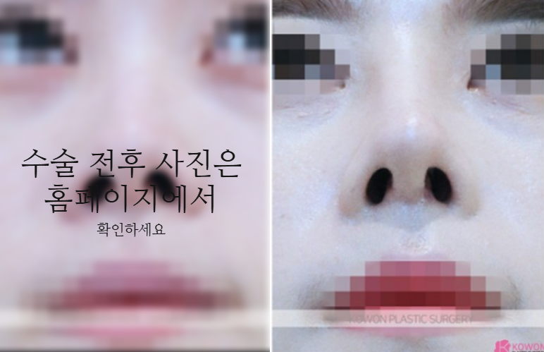 작은코성형에서 입체감 있는 코 라인을 만드는 핵심 3가지 사진 8