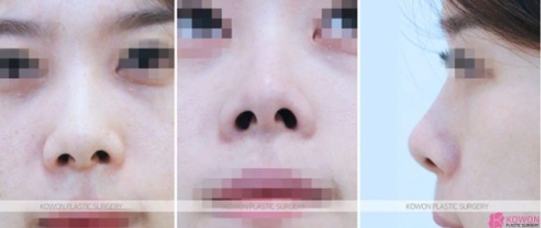 작은코성형에서 입체감 있는 코 라인을 만드는 핵심 3가지 사진 5