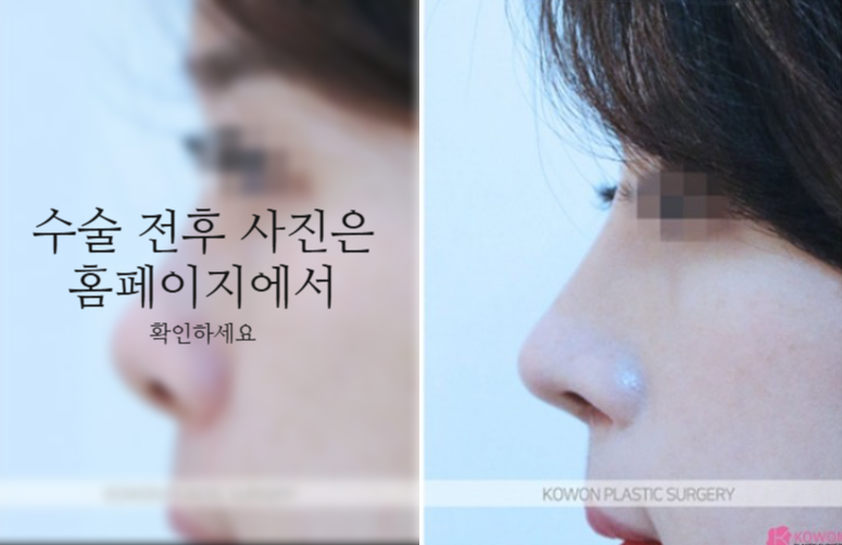 작은코성형에서 입체감 있는 코 라인을 만드는 핵심 3가지 사진 6